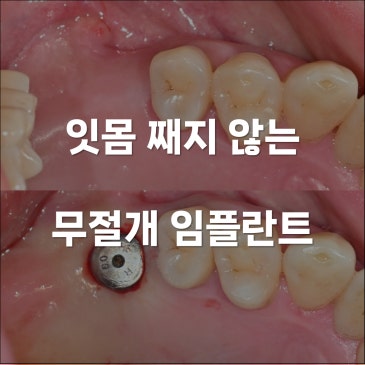 무절개 임플란트 잇몸 안 째고 심는 이유