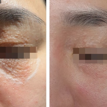 한관종·점·사마귀 구별하는 방법, 레이저 시술(한관종 경과사진포함)