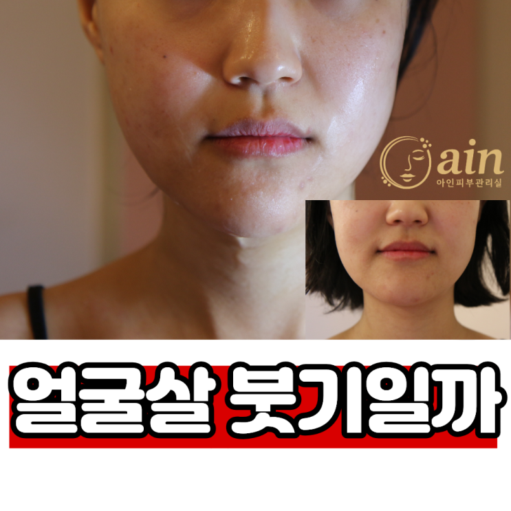 얼굴 붓기빼는법, 얼굴살처럼 보여도 붓기일까? 얼굴부종관리 기준 : 네이버 블로그