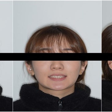 충주시치과에서 앞니 크라우딩으로 인한 재교정, 부분교정으로 단기간 개선한 사례