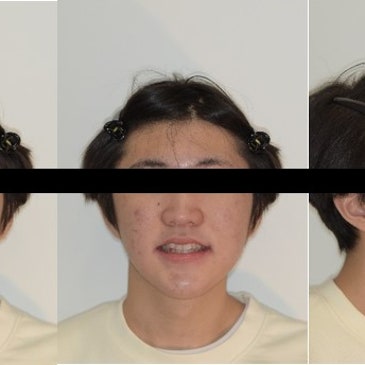 봉방동교정치과에서 3급 부정교합 개선한 사례