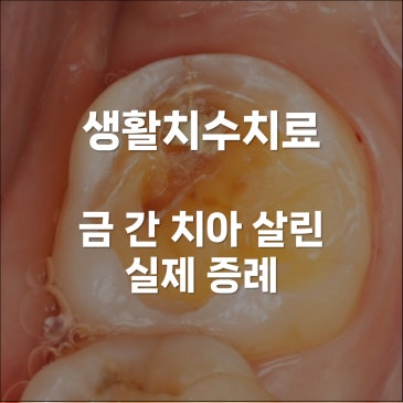 생활치수치료 금 간 치아 살린 실제 증례