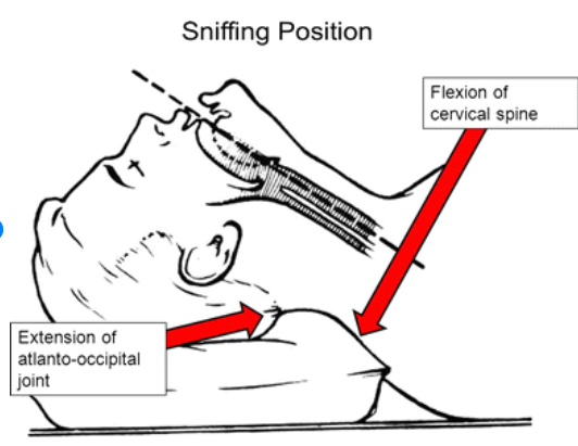 기관내삽관(Intubation) 정리 – ICU 간호사를 위한 실무 가이드 – : 네이버 블로그