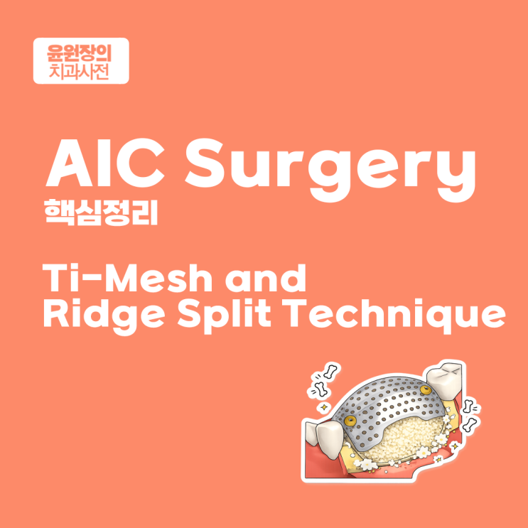 AIC Surgery 코스 3주차 핵심정리 | Ti-Mesh and Ridge Split Technique : 네이버 블로그