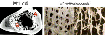 골다공증이란? 원인부터 예방법, 치료법, 좋은 음식까지 한눈에 정리 : 네이버 블로그