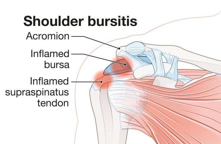 1)견봉하-삼각근하 점액낭염(SASD bursitis) : 네이버 블로그