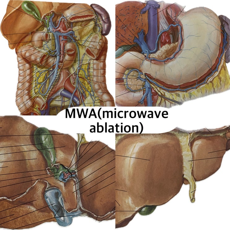 Microwave Ablation (MWA, 마이크로웨이브 소작술), RFA vs MWA 차이점 : 네이버 블로그