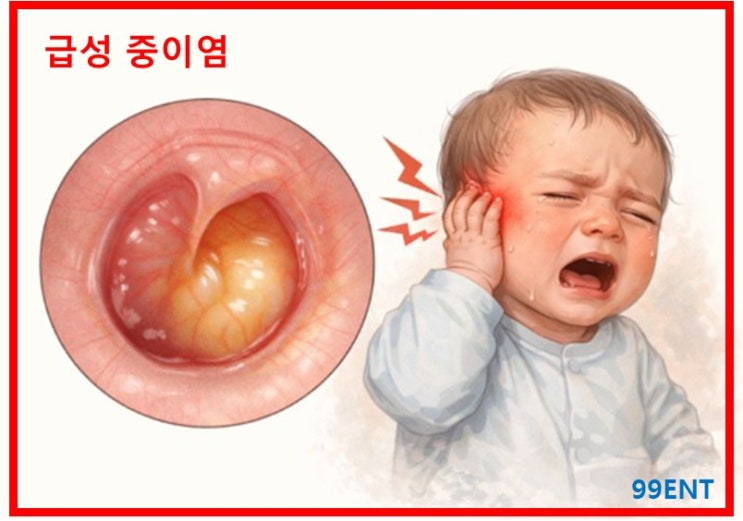 소아 [급성 중이염]에 대한 Q&A : 네이버 블로그