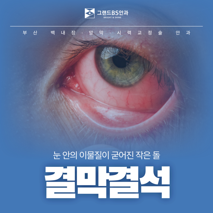 부산 서면 안과 눈 속에 돌이 생겼다? 결막결석 원인과 치료 방법은? : 네이버 블로그