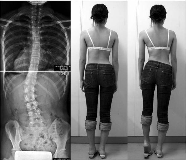 측만증 교정운동으로 알려진 크랩스운동(Klapp's exercise), 정말 효과 있을까? : 네이버 블로그