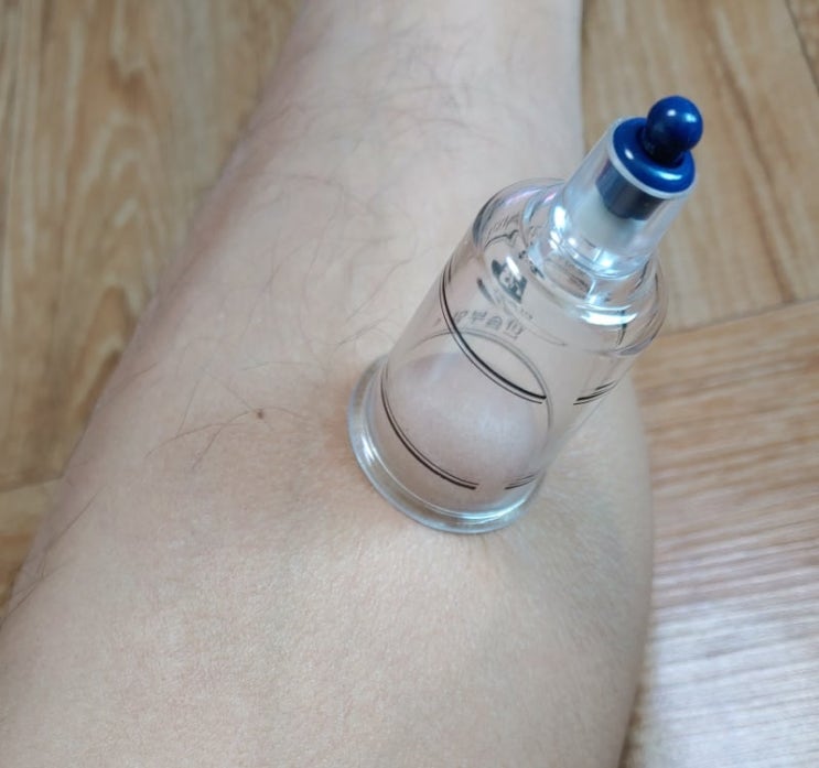사혈 하는법 : 네이버 블로그