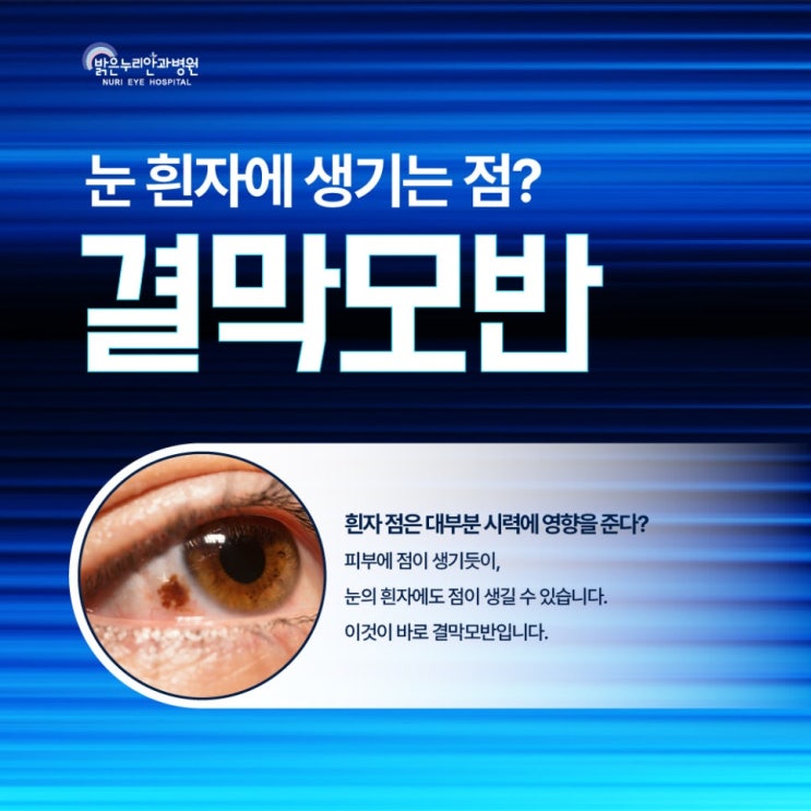 결막모반 제거 후에도 재발할 수 있을까? 막는 방법 정리 : 네이버 블로그