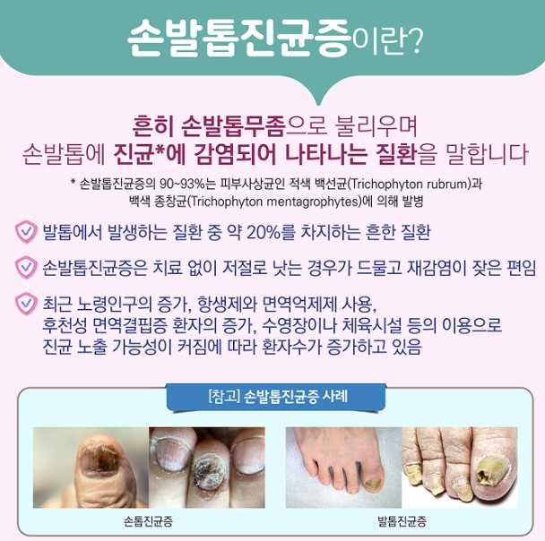 손발톱 무좀 증상과 원인(+치료 방법,손발톱진균증) : 네이버 블로그
