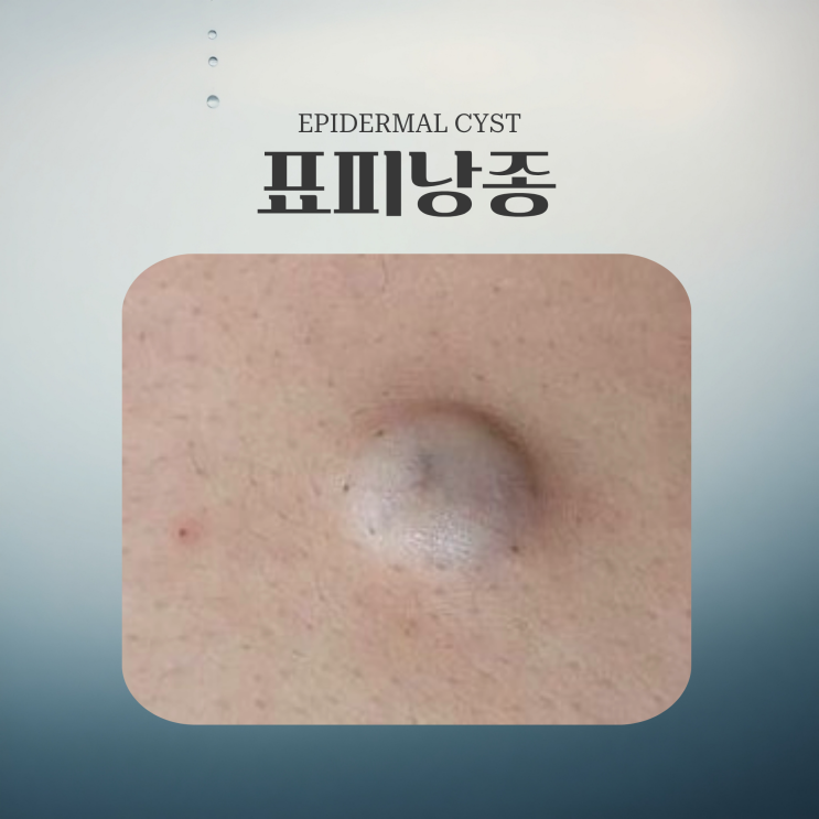 표피낭종 성형외과에서 수술로 치료해요 : 네이버 블로그