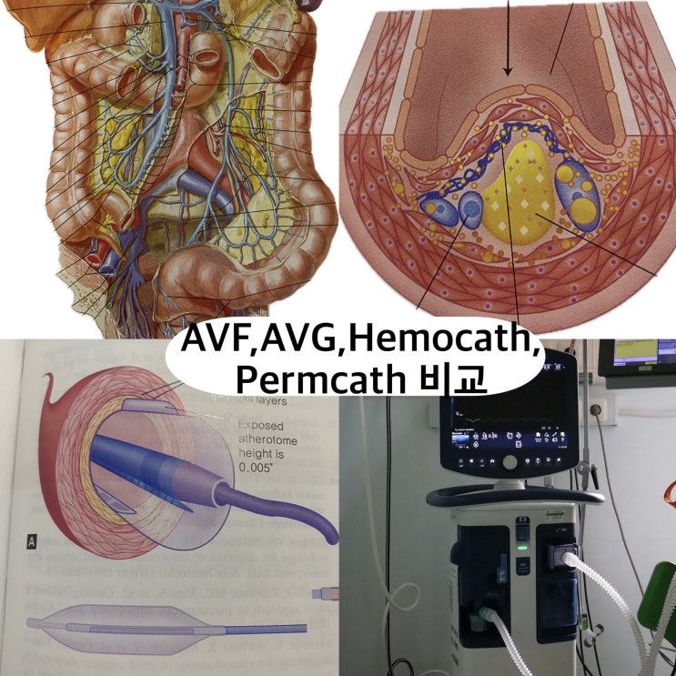 AVF · AVG · Hemocath · Perm Cath 혈액투석 혈관 접근로 비교 정리 : 네이버 블로그