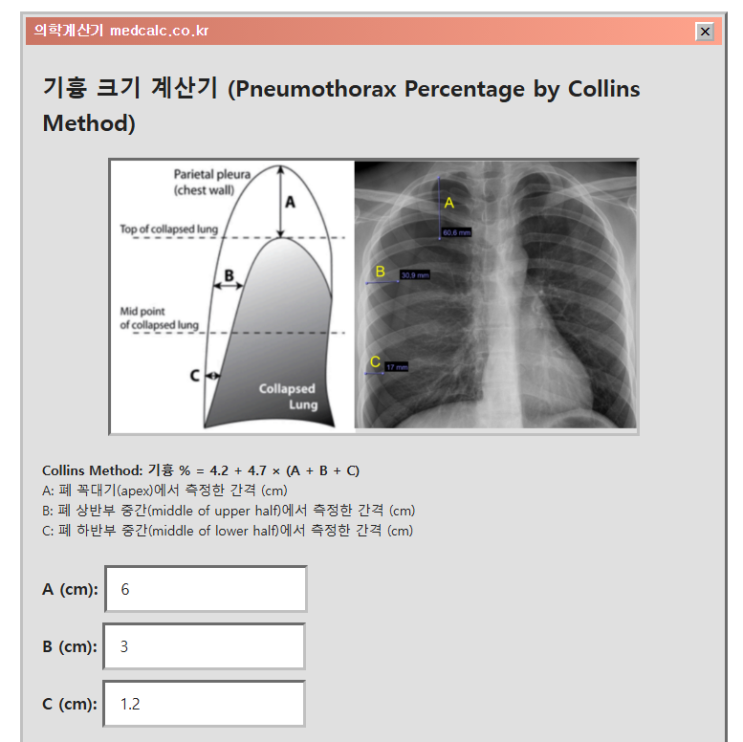 기흉 크기 계산기 (Pneumothorax Percentage by Collins Method) : 네이버 블로그