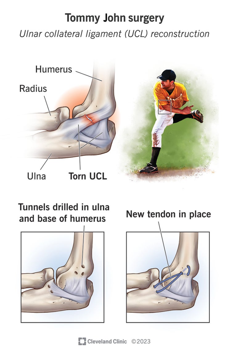 척골측부인대 재건술(Ulnar Collateral Ligament Reconstruction)임상 연구 : 토미존 수술과 재활 ...