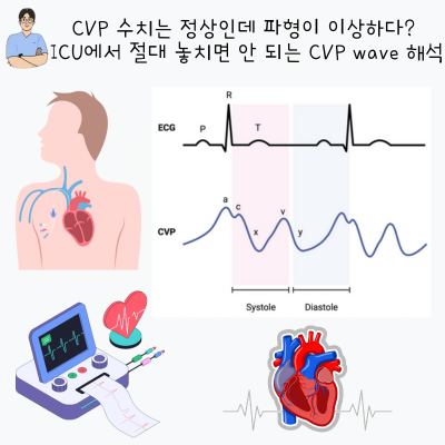 CVP 수치는 정상인데 파형이 이상하다? ICU에서 절대 놓치면 안 되는 CVP wave 해석 : 네이버 블로그