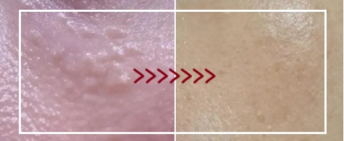 피부 요철 시술 후기 홈케어 관리 필수 : 네이버 블로그