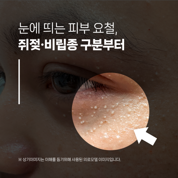 장유쥐젖비립종제거, 피부 요철, 종류부터 확인해봐요! : 네이버 블로그