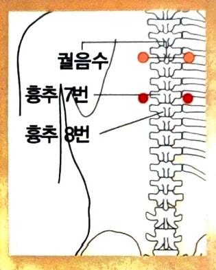 [부항 사혈] 왜?격수(膈腧)혈을 사혈하면 소화불량, 찬 음식을 급하게 먹고 딸국질할 때 바로 멈출까? : 네이버 블로그
