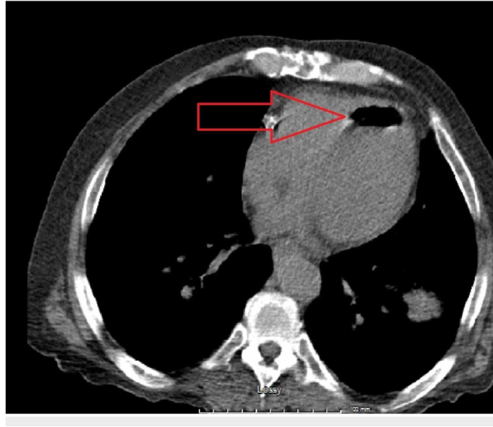 공기 색전증 (Air Embolism) : 네이버 블로그