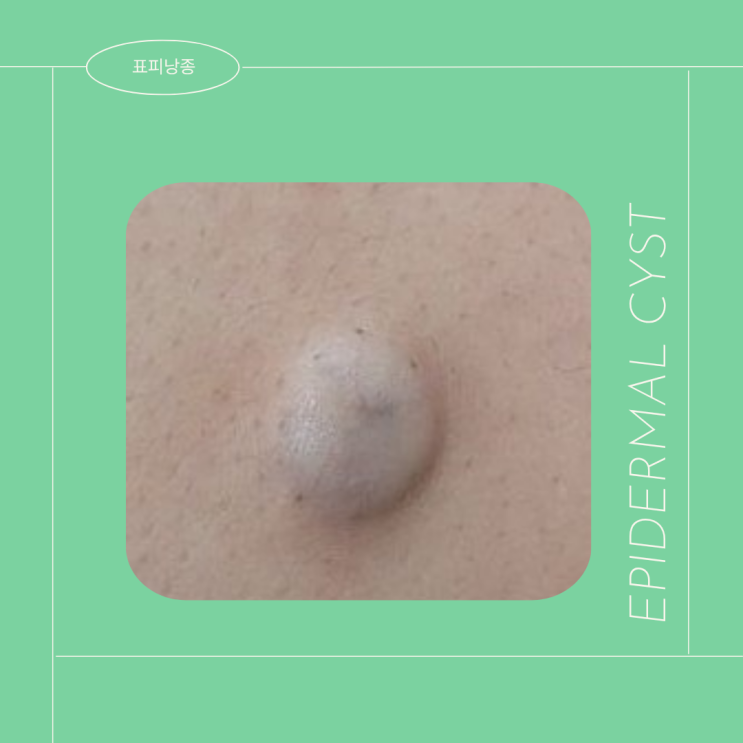 Epidermal cyst 표피낭종 염증 전에 제거해요 : 네이버 블로그