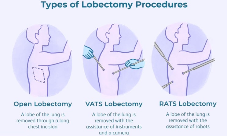 Empyema 농흉 치료 VATS 의학용어, Lobectomy 와 Decortication 차이가 뭘까요? : 네이버 블로그