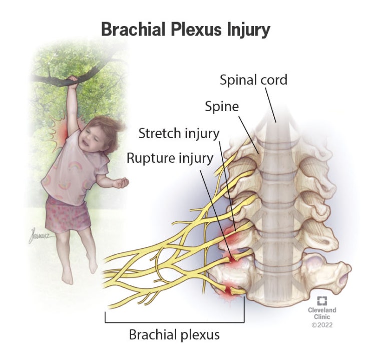 상완신경총 손상(Brachial Plexus Injury, BPI) : 네이버 블로그