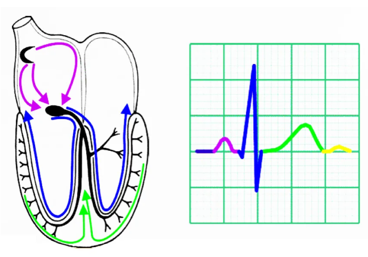 심장전도이상, 서맥 EKG, ECG - sinus pause, AV block, junctional rhythm, RBBB ...
