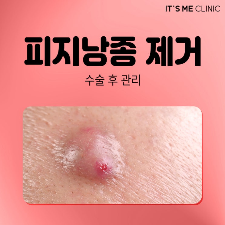 송도 피지낭종 제거 수술 후 관리 의사가 알려드림 : 네이버 블로그