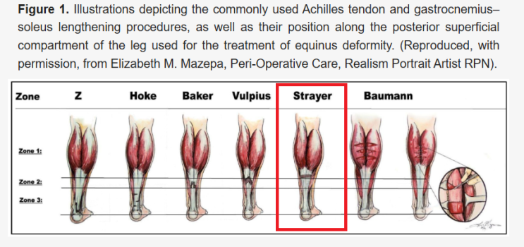 아킬레스건 연장술(Tendo achilles lengthening) 및 Strayer 술식 : 네이버 블로그