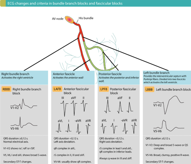 부정맥 각차단(BBB, Bundle Branch Block) : RBBB, LBBB : 네이버 블로그