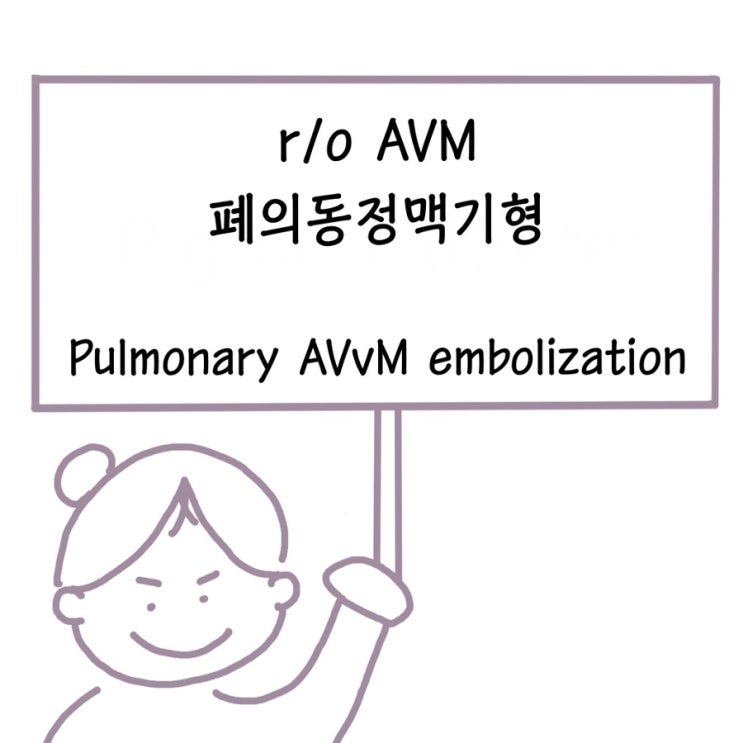 r/o AVM ( 폐의 동정맥 기형 Arteriovenous malformation, lung ) embolization ...