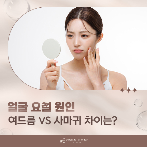 얼굴 요철 원인 여드름 VS 사마귀 차이 내 피부 구별법 : 네이버 블로그