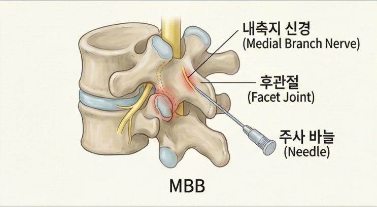 허리 주사치료, 이제는 알고 맞자! 종류별 완벽정리! (MBB, SNRB, LSEB, Caudal block) : 네이버 블로그