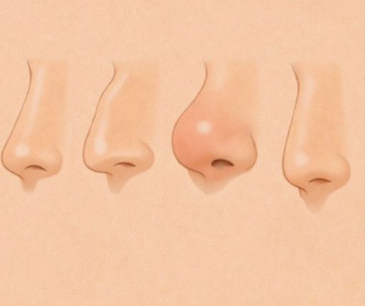코 물혹 원인, 자연치유, 터짐, 증상, 생기는이유, 제거, 재발 : 네이버 블로그