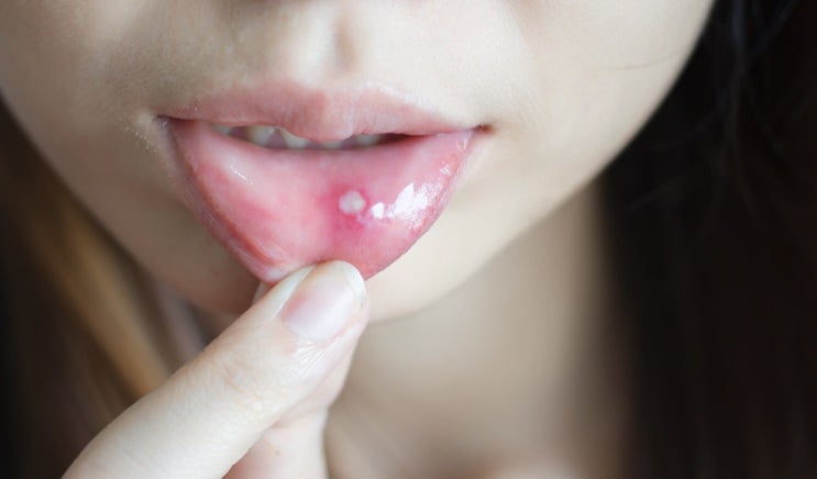 입 안이 자주 헐어요? 구내염(입병) 원인부터 치료·예방까지 한 번에 정리 : 네이버 블로그