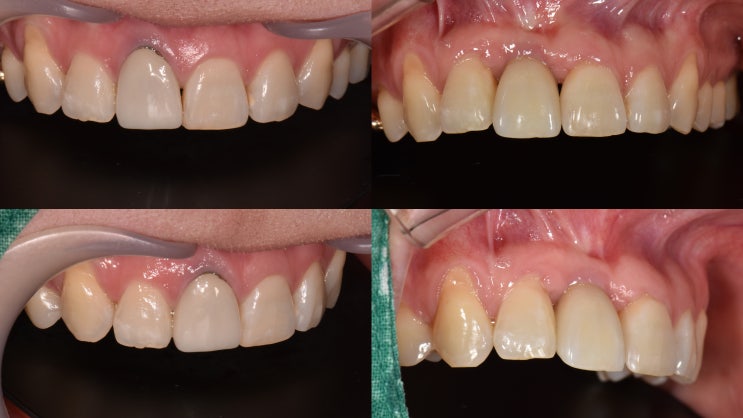 스트라우만 BLT SC 2.9mm 가장 가는 bone level implant straumann 앞니 외산 임플란트 : 네이버 블로그