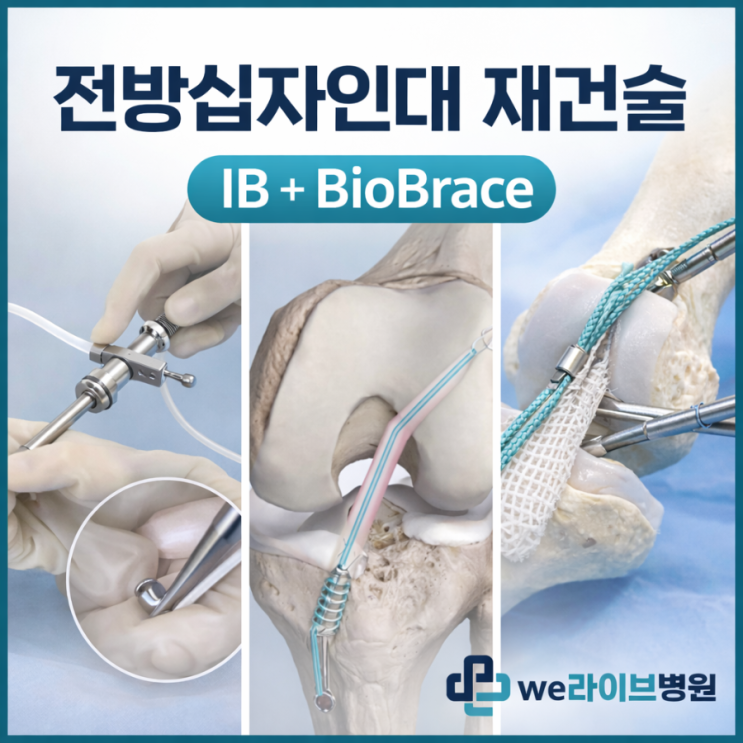 전방십자인대 재건술, IB 기본 적용에 BioBrace를 더하다 : 네이버 블로그