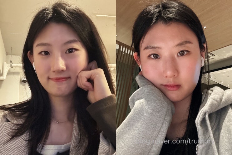 쌍수) 32년 무쌍 끝! 자연스러운 자연유착 1일차~14일차 후기 / 쌍수 준비물 추천템 : 네이버 블로그
