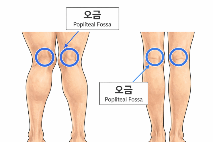 무릎 오금 위치 = 무릎 뒤쪽이 접히는 오목한 부분(슬와부, popliteal fossa)ㆍ퇴행성관절 무릎베게/ 무릎통증,무릎 ...