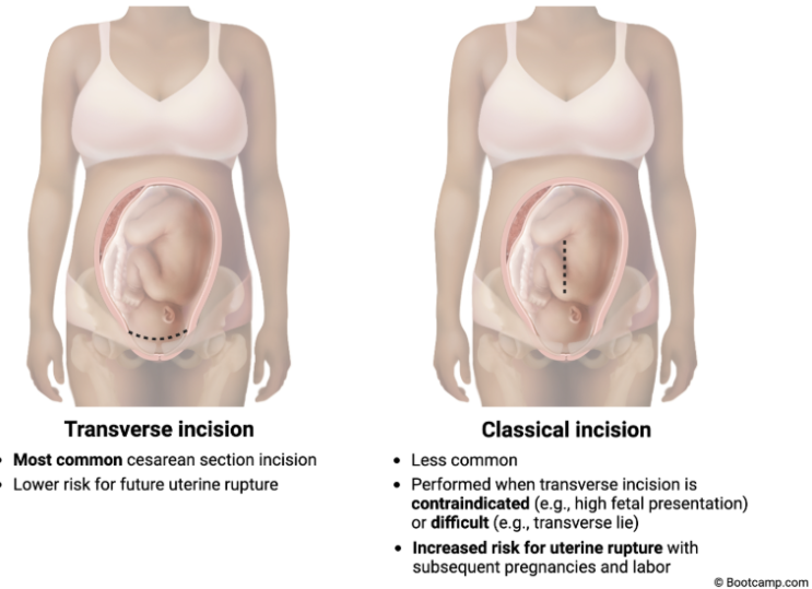 (laber) Preterm Labor : 네이버 블로그