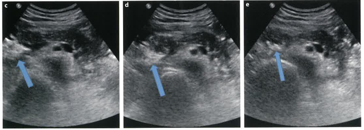 [복부초음파] 상복부 췌장 초음파 - 1. 급성 췌장염 (Acute Pancreatitis) : 네이버 블로그