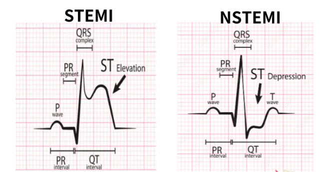 ACS 정리 : STEMI / NSTEMI 차이부터 응급실 재관류 프로토콜까지 한눈에 : 네이버 블로그