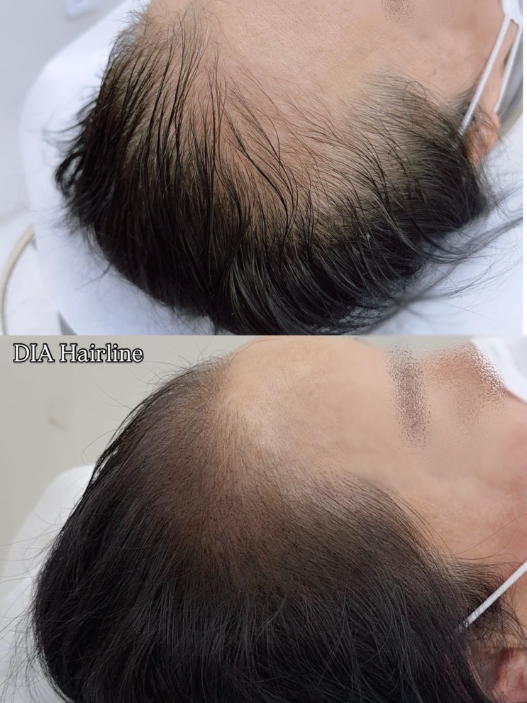 세종 헤어라인 문신 | 전두부탈모·빈모 고민, 뷰티모후 다이아헤어라인으로 흑채 없이 출근해요