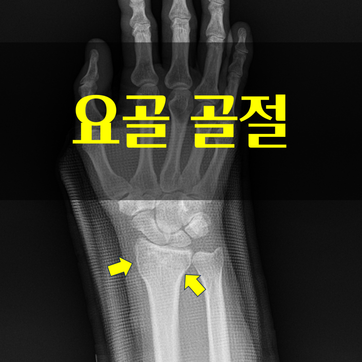 손목 원위부 요골 골절 회복 기간과 필요한 영양소 : 네이버 블로그