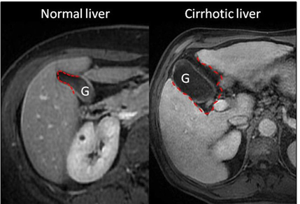 담낭와 확장 징후, expanded gallbladder fossa sign 연관 자료 : 네이버 블로그