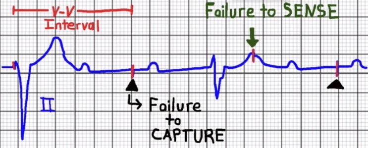 Pacemaker 모드 Sensing, Capturing, Pacing 공부하기 post-CABG 수술 후 사용하는 ...