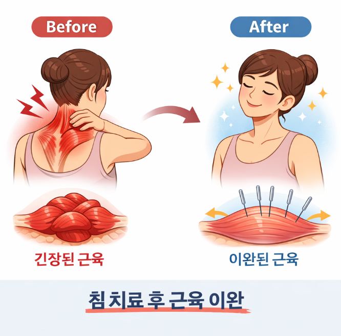 침 맞으면 왜 시원할까요? 한의사가 설명드립니다 | 안성경희365한의원